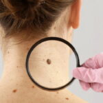 dermatoloji-uzmani-acikladi-benlerdeki-degisiklikleri-hafife-almayin-RKeriGEu